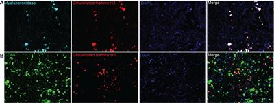 Intratumoral neutrophil extracellular traps are associated with unfavorable clinical outcomes and immunogenic context in pancreatic ductal adenocarcinoma